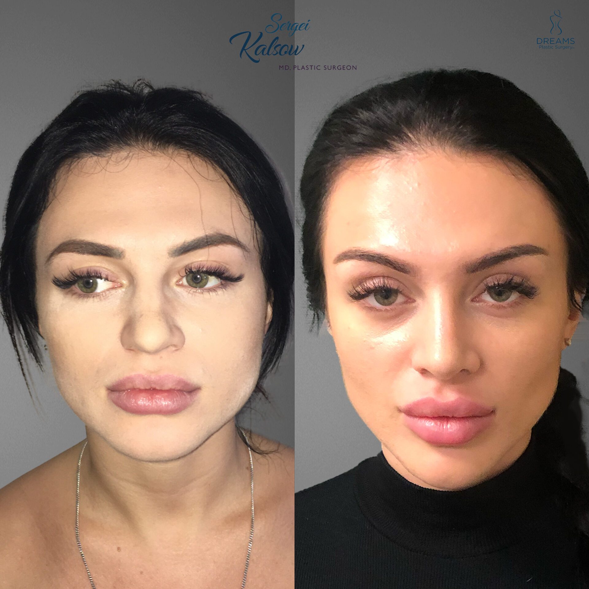 Facelift before and after result case 1