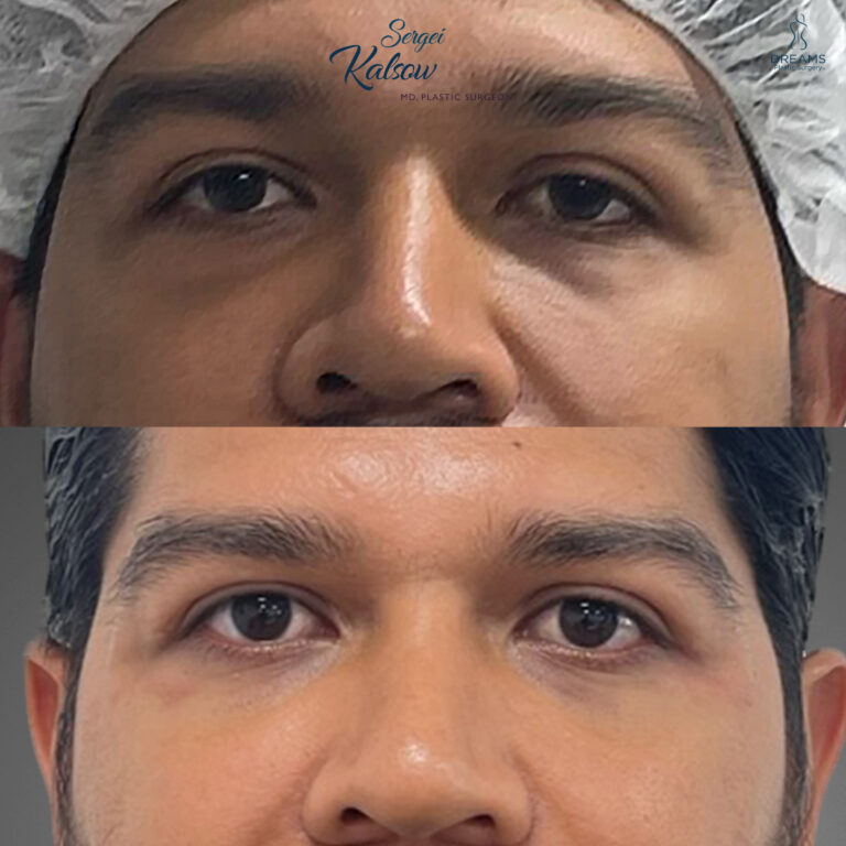 Eyelid rejuvenation for men before and after New York City case 3
