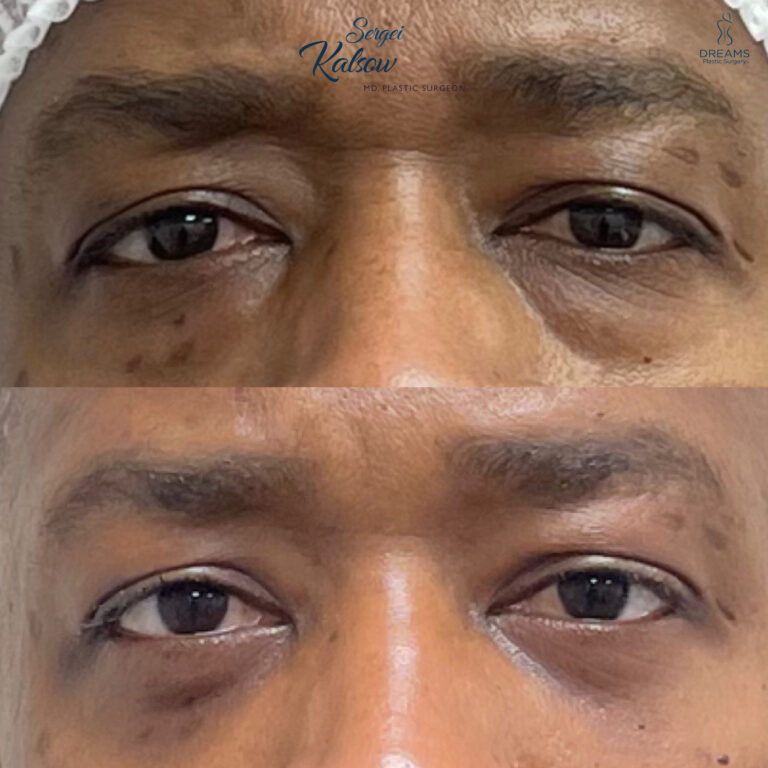 Male blepharoplasty before and after NYC case 2
