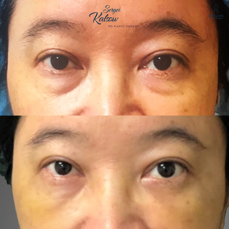 Male eyelid rejuvenation before and after NYC case 1