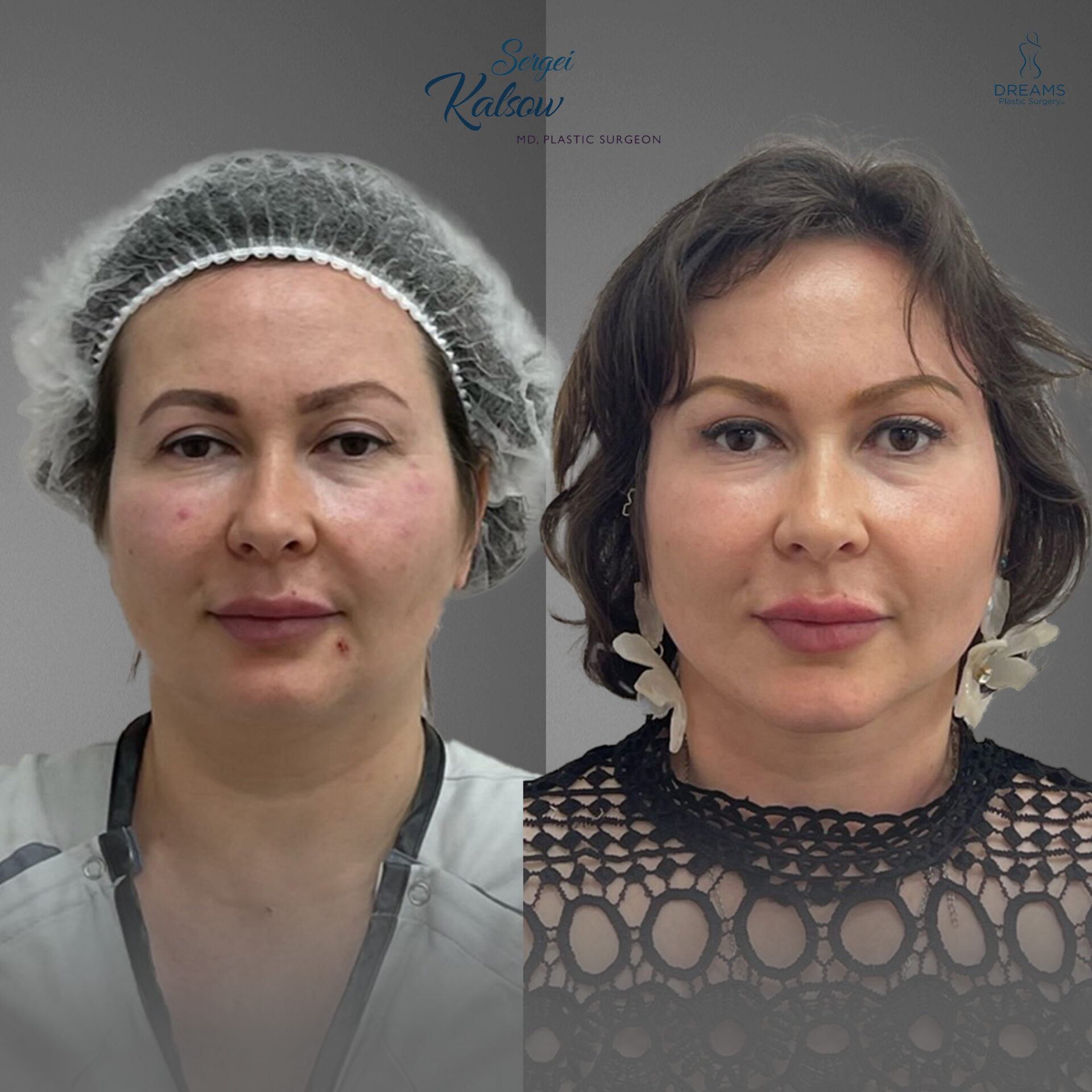 Facelift before and after result case 2