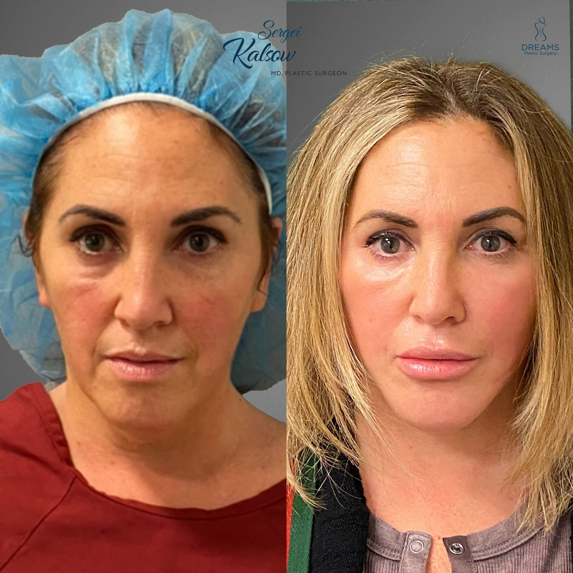 Facelift before and after result case 3