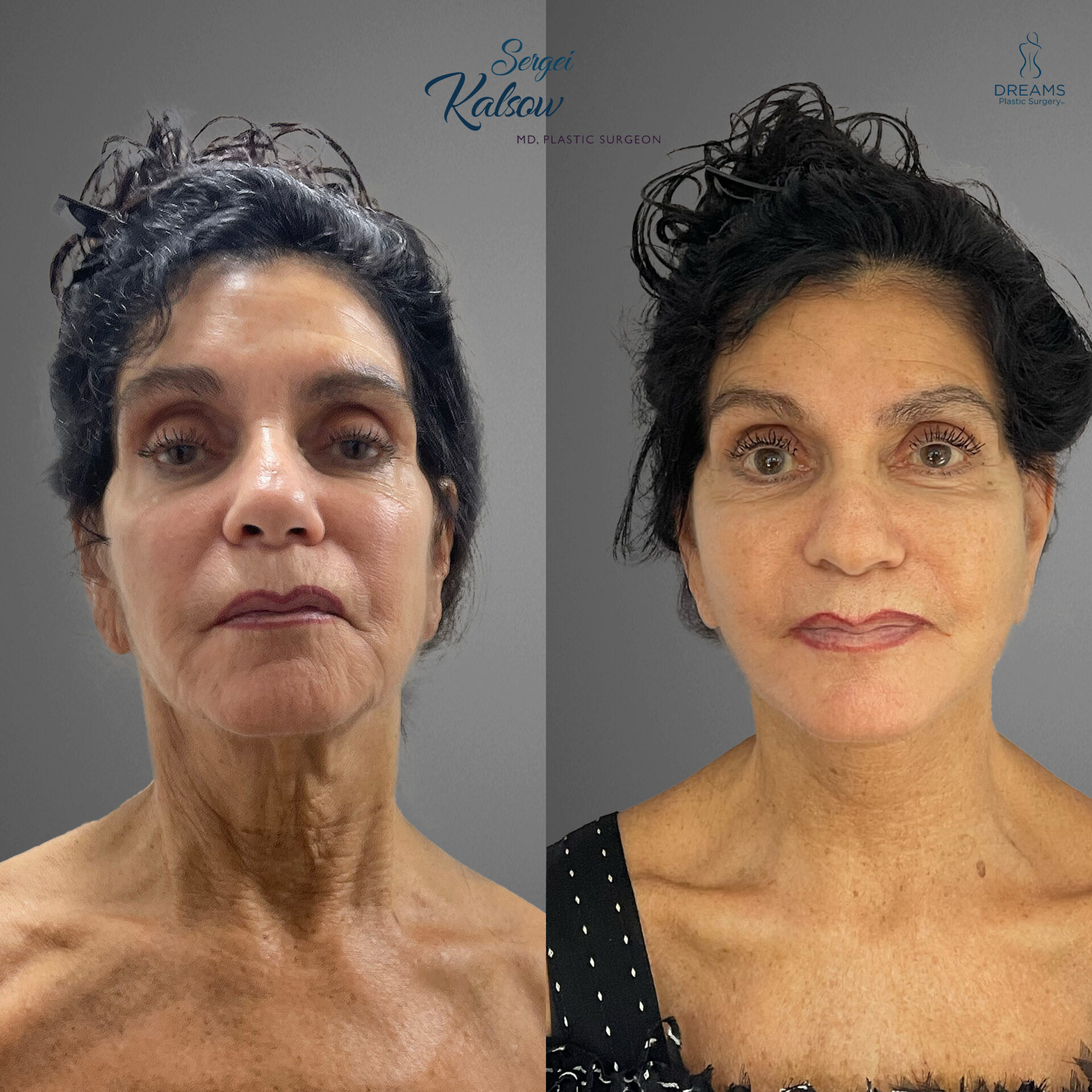 Facelift before and after result case 4