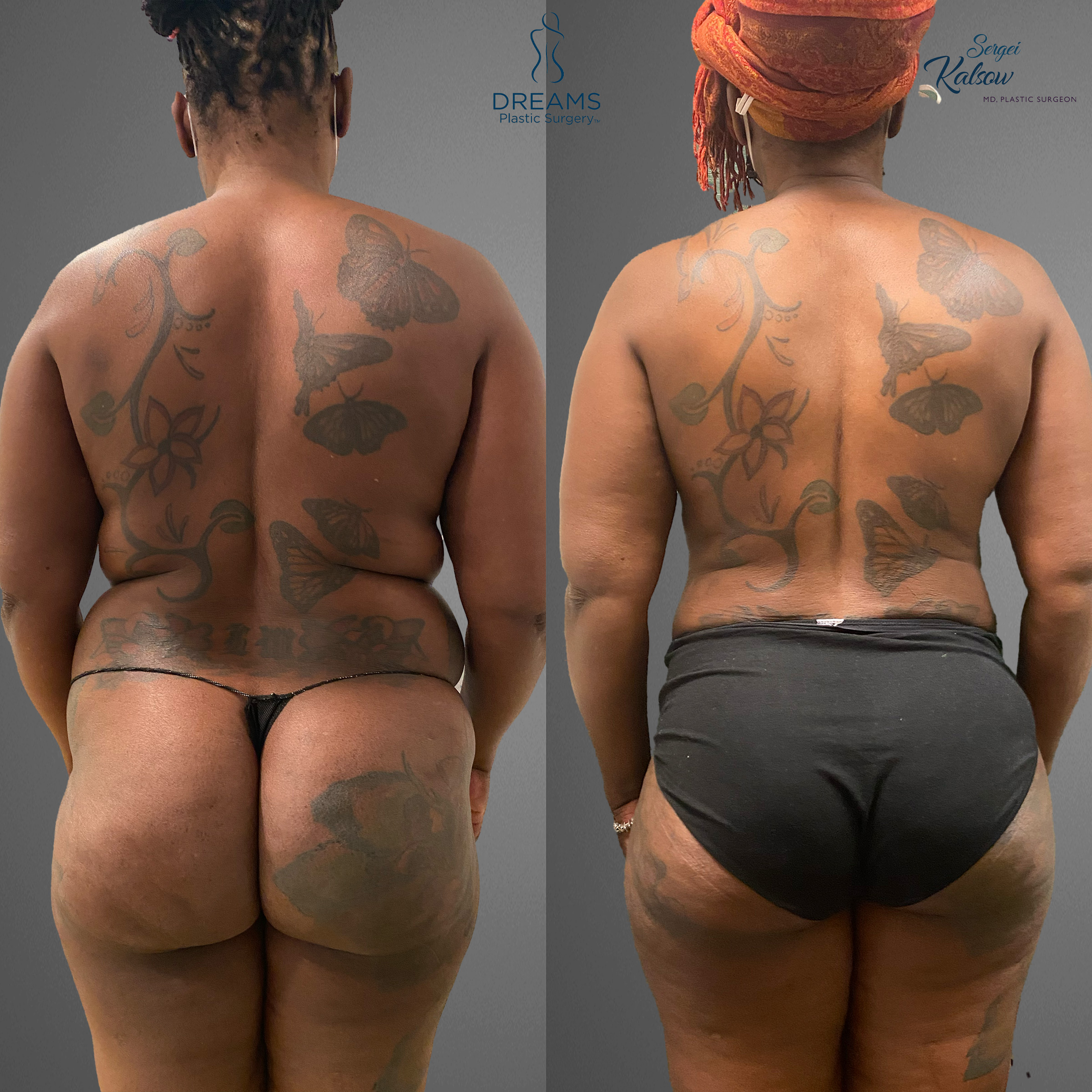 Mommy makeover before and after result case 1