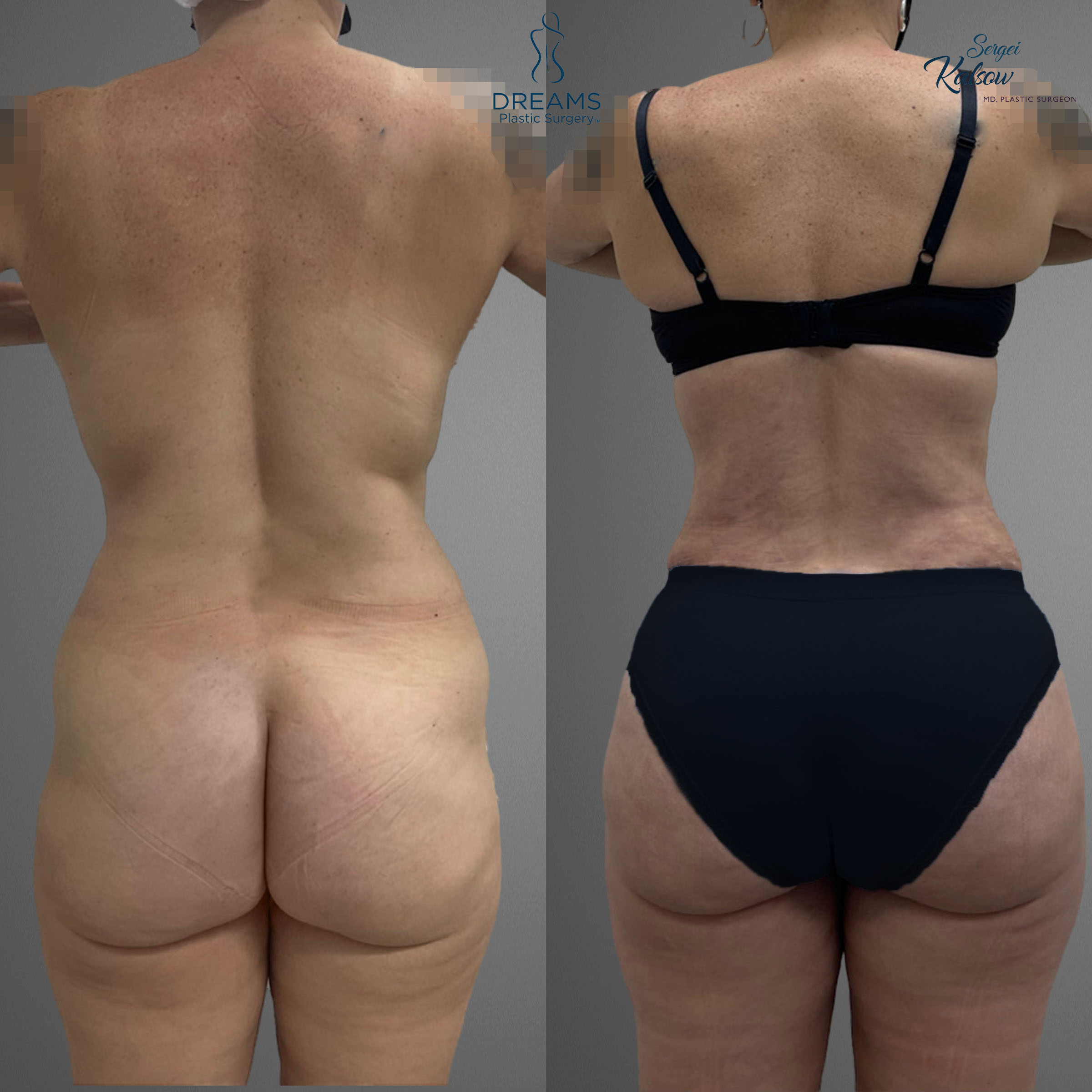 Lipo 360 BBL body contouring before and after result