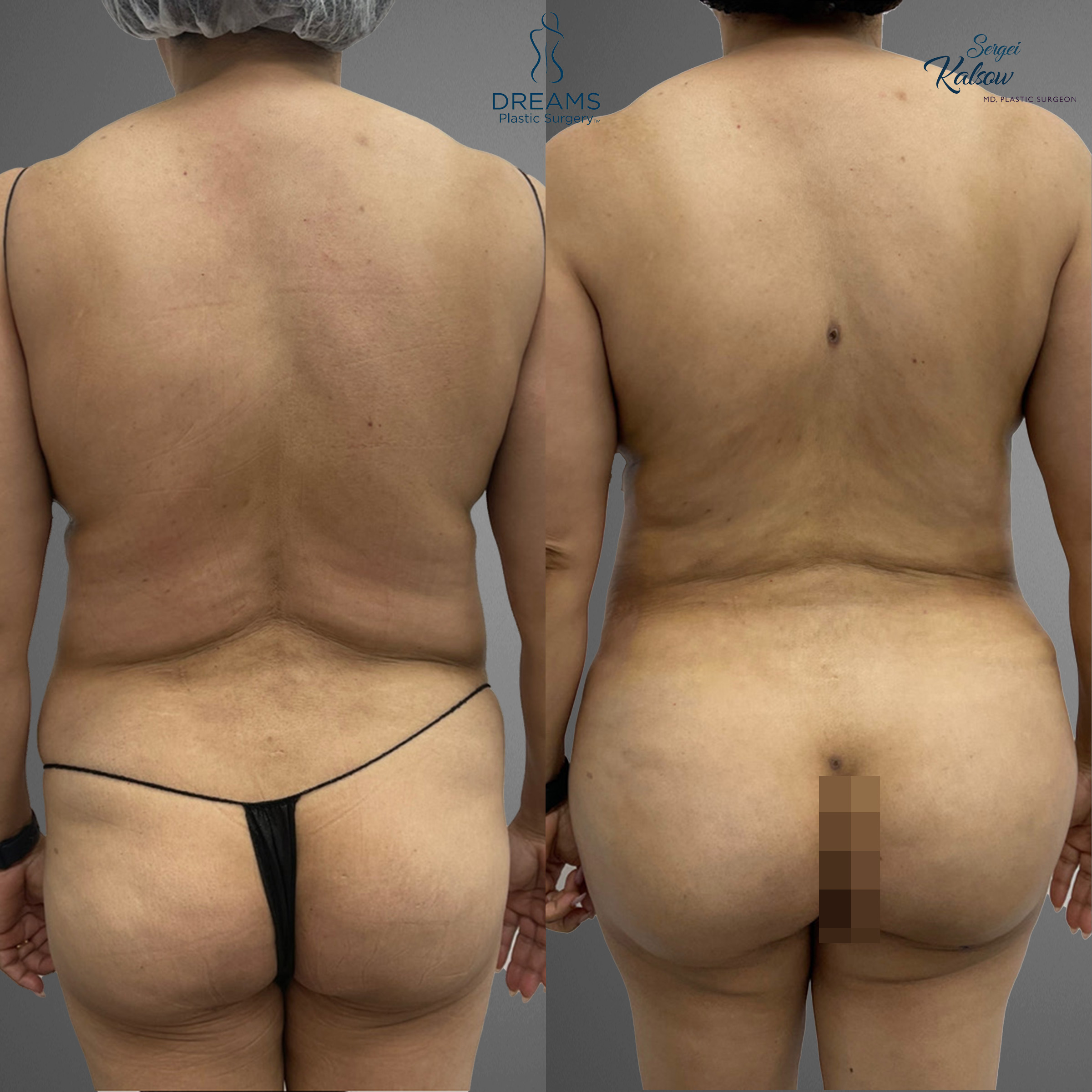 Lipo 360 BBL before and after body contouring result