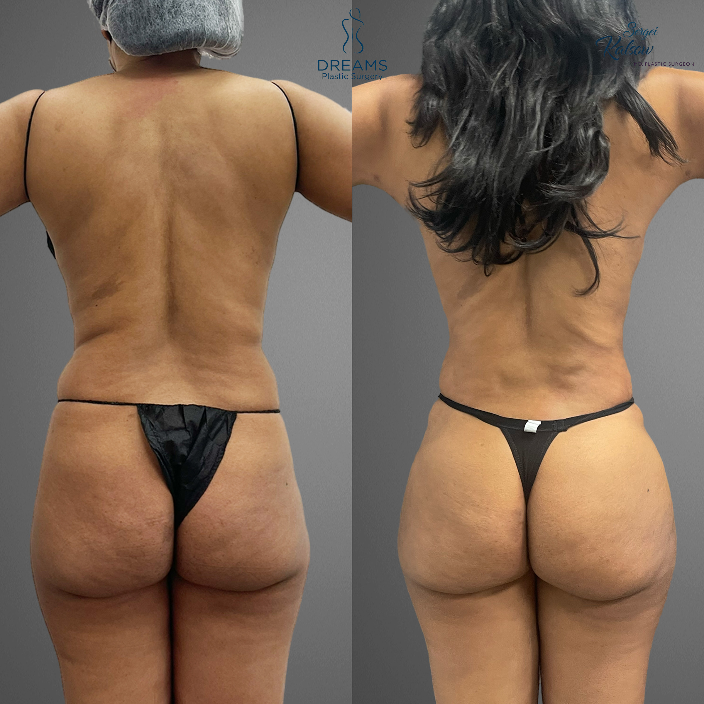 Liposuction body contouring before and after result