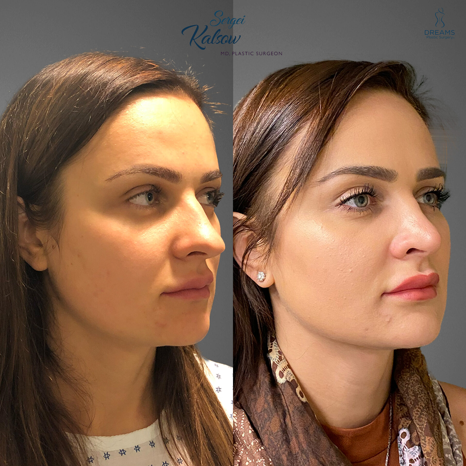 Female rhinoplasty before and after result at Dreams Plastic Surgery