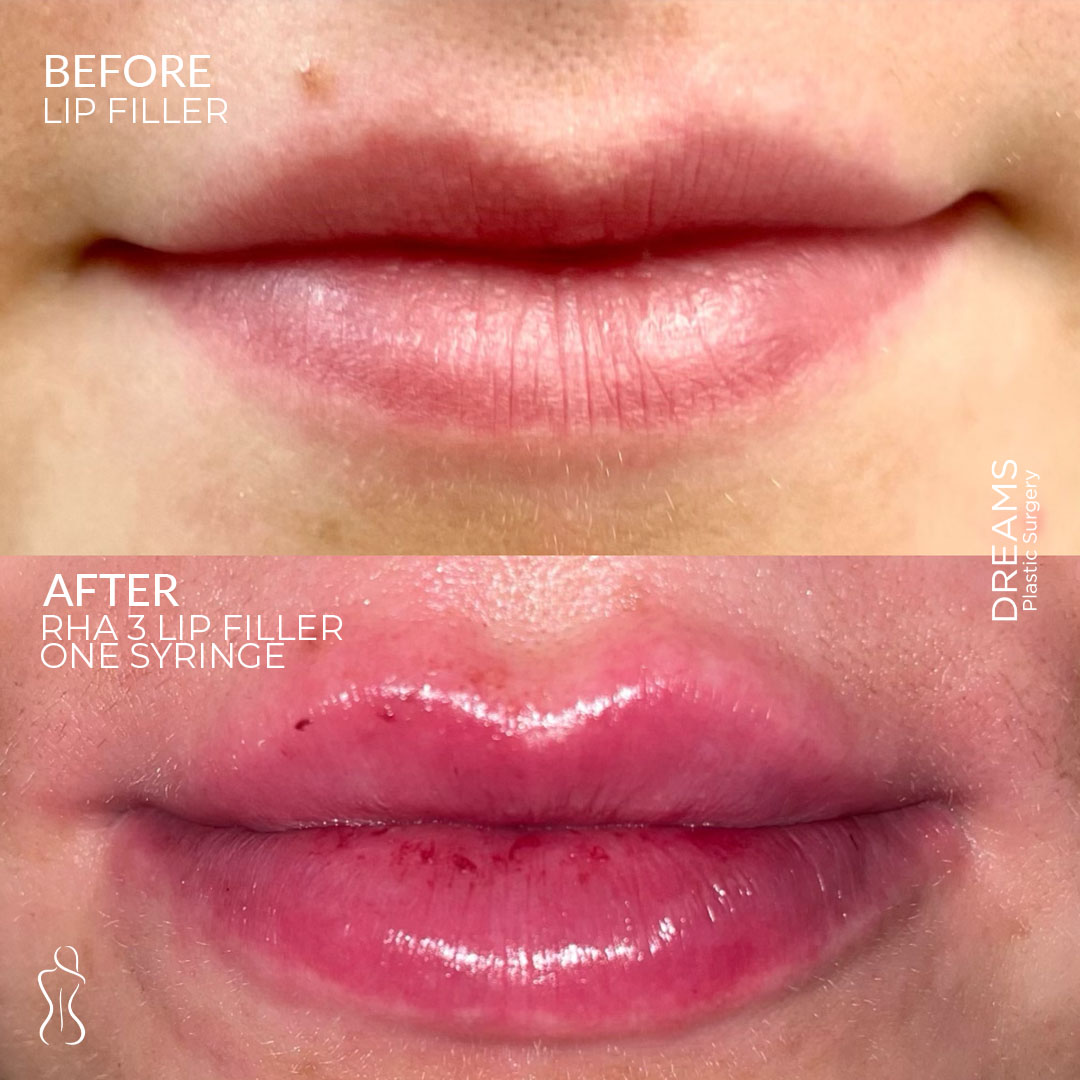 Lip filler before and after result case 2