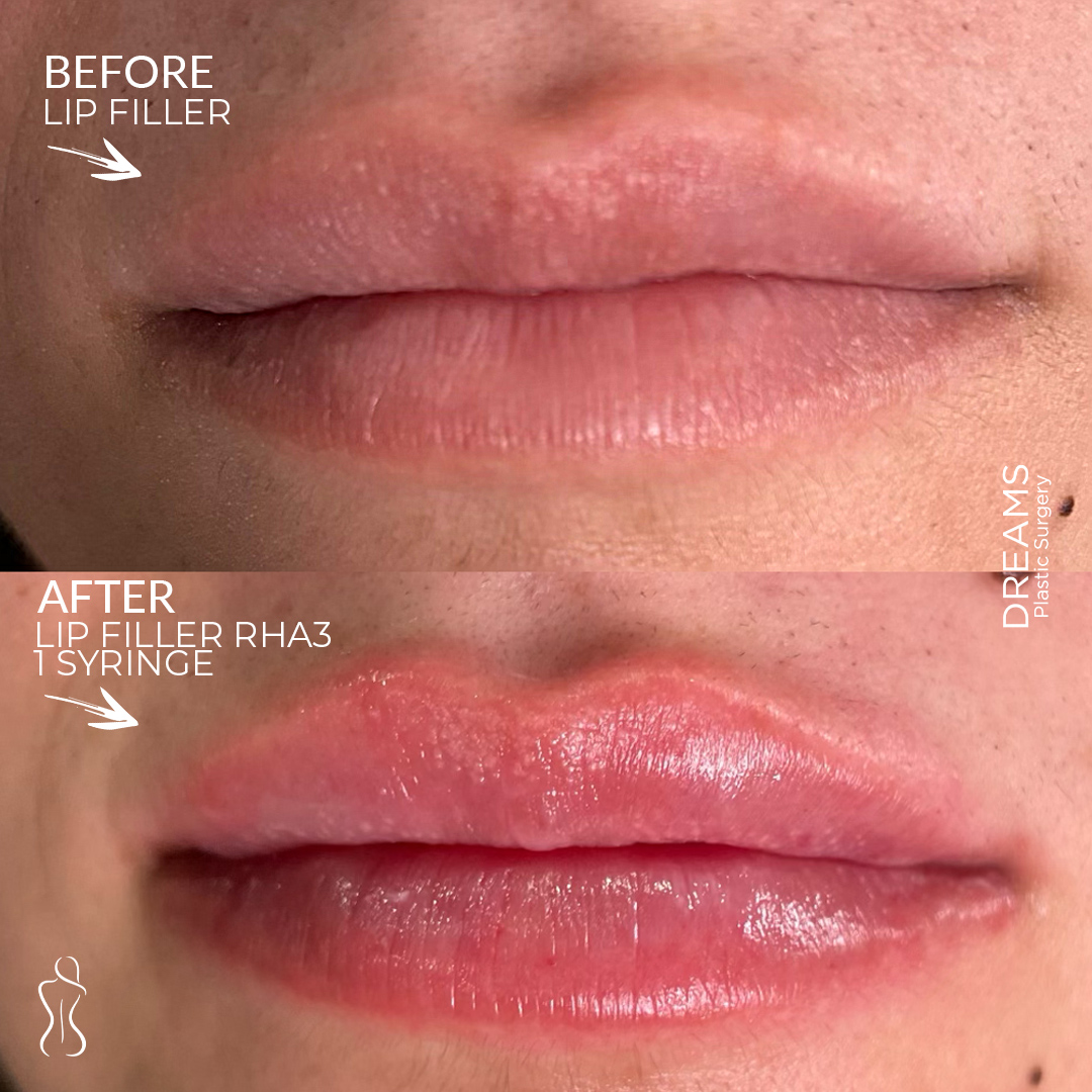 Lip augmentation before and after result case 3