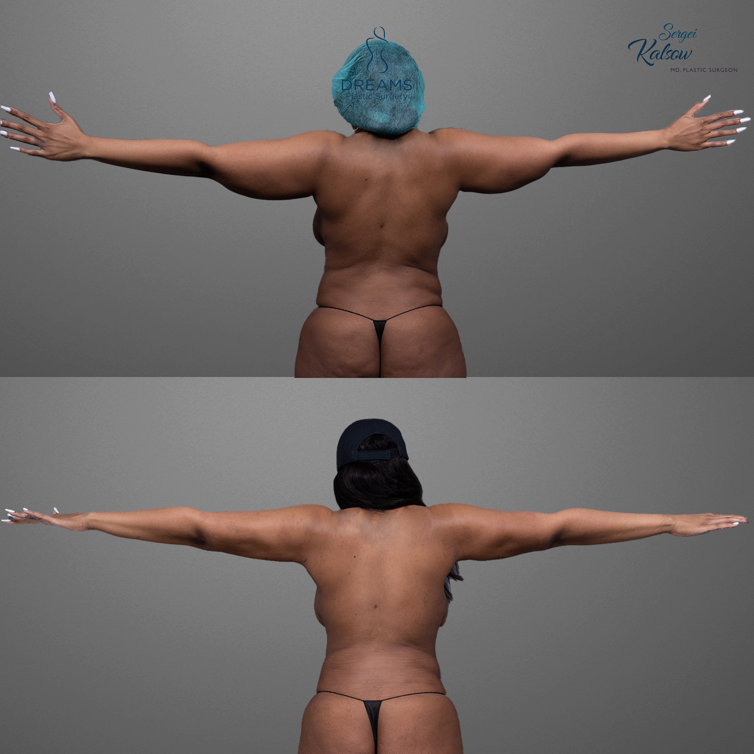 Liposuction before and after arms and back result