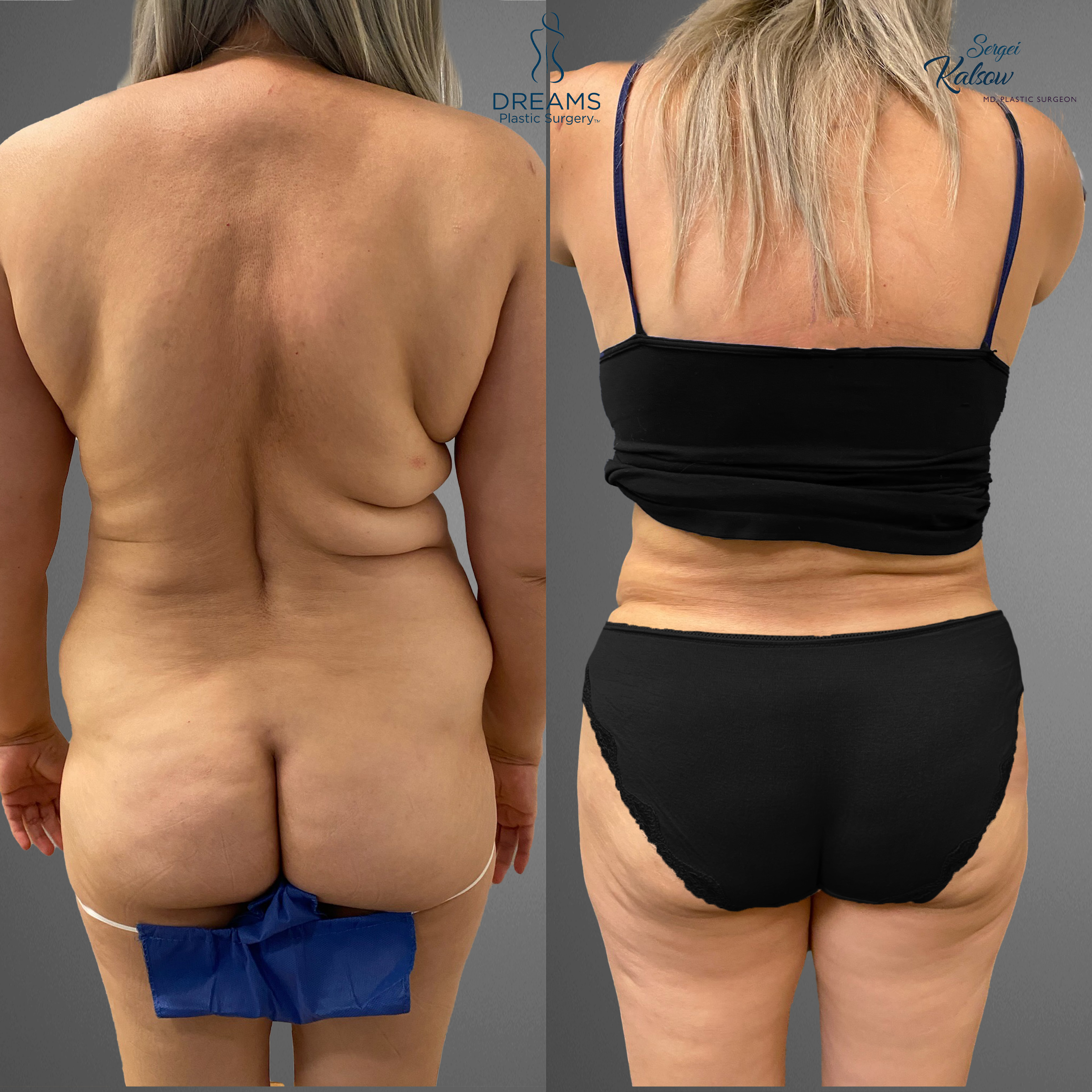 Mommy makeover back view before and after result
