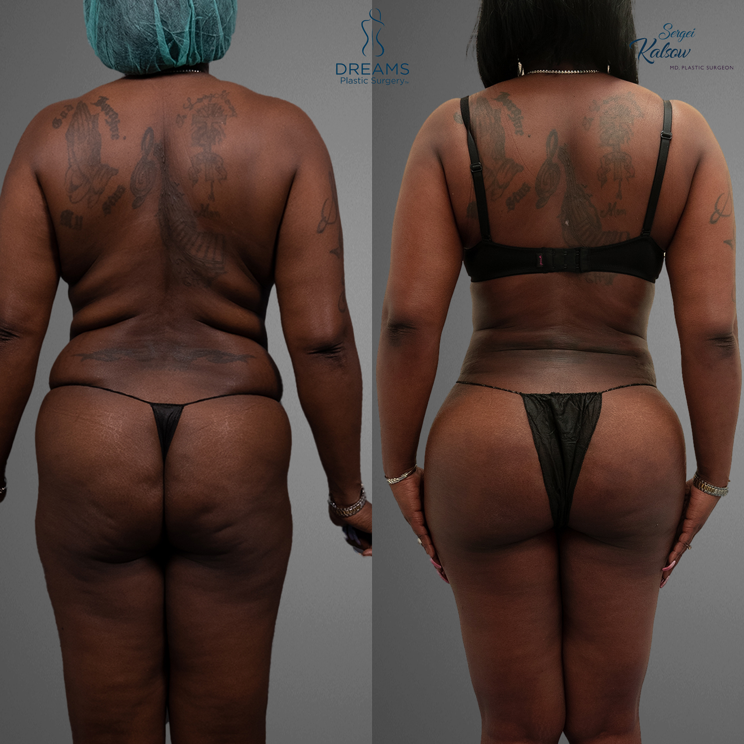 Liposuction before and after back result
