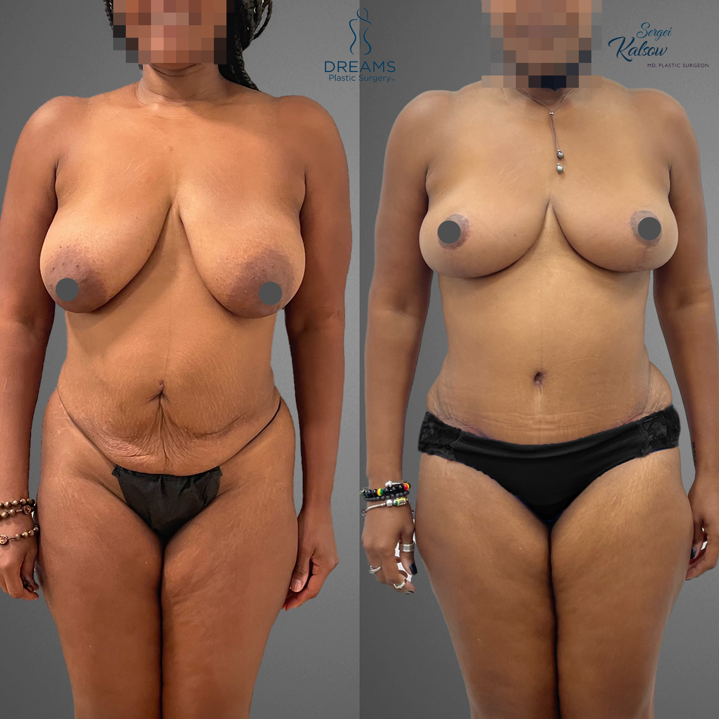 Mommy makeover front view before and after result case 5