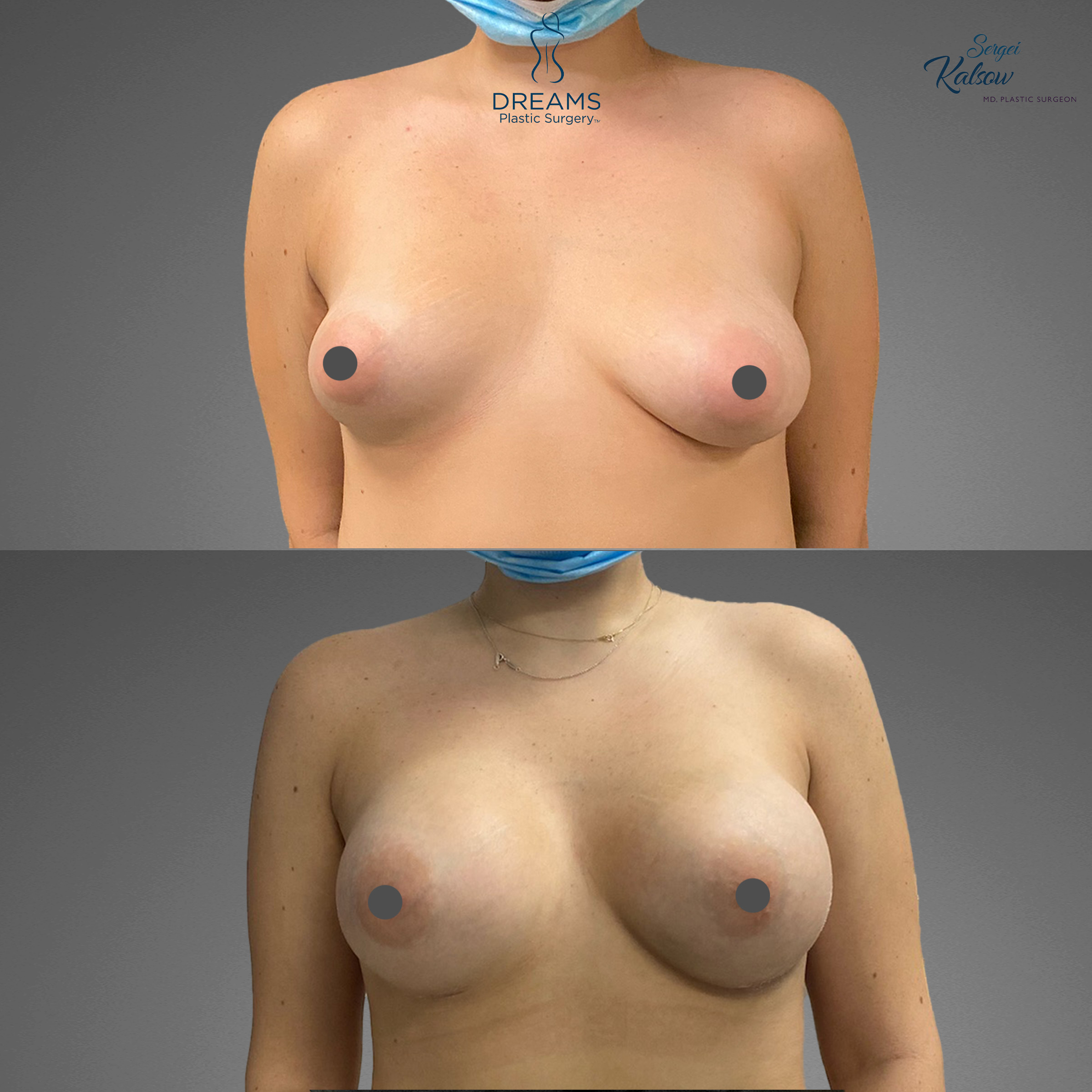 Breast augmentation before and after result case 1