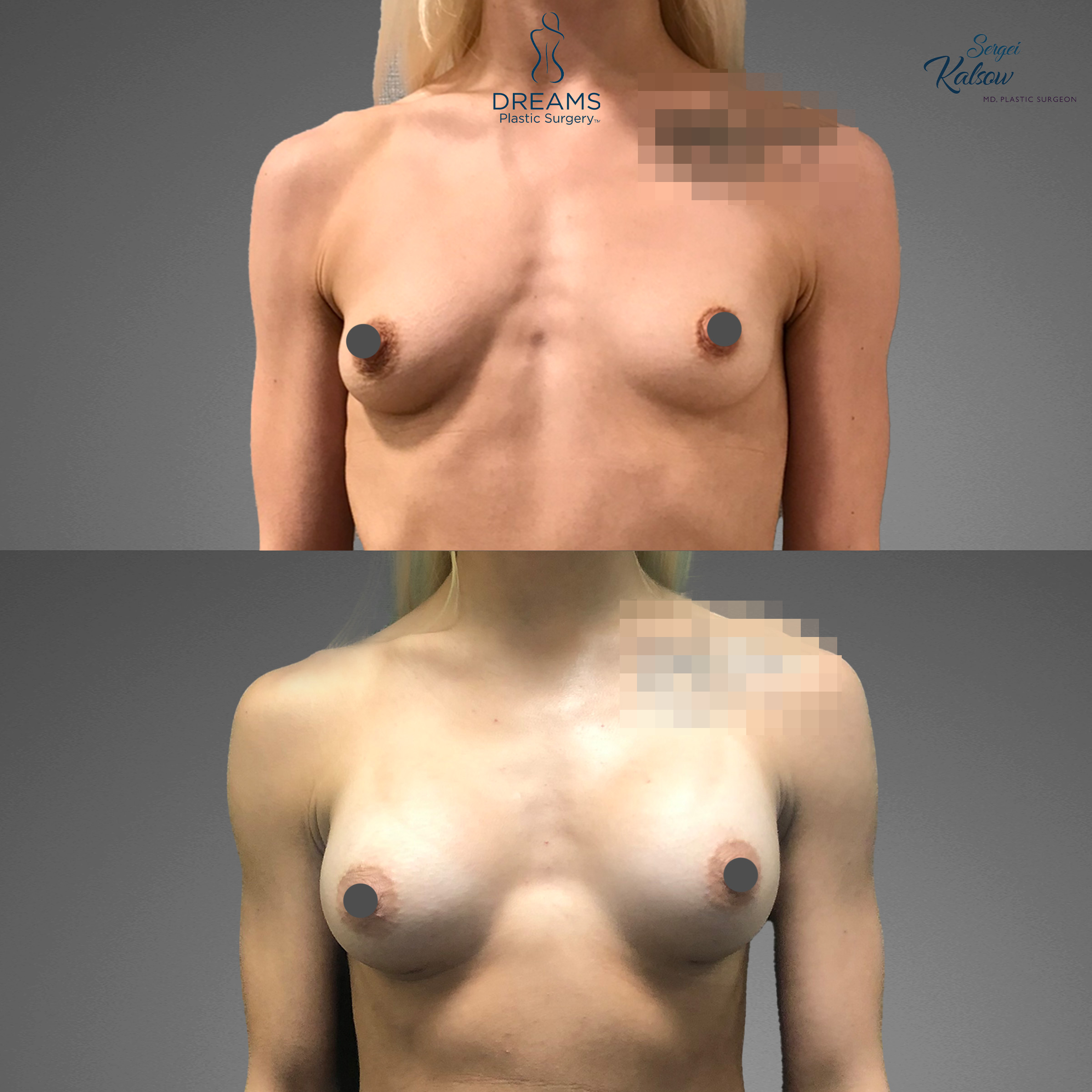Breast augmentation before and after result case 2
