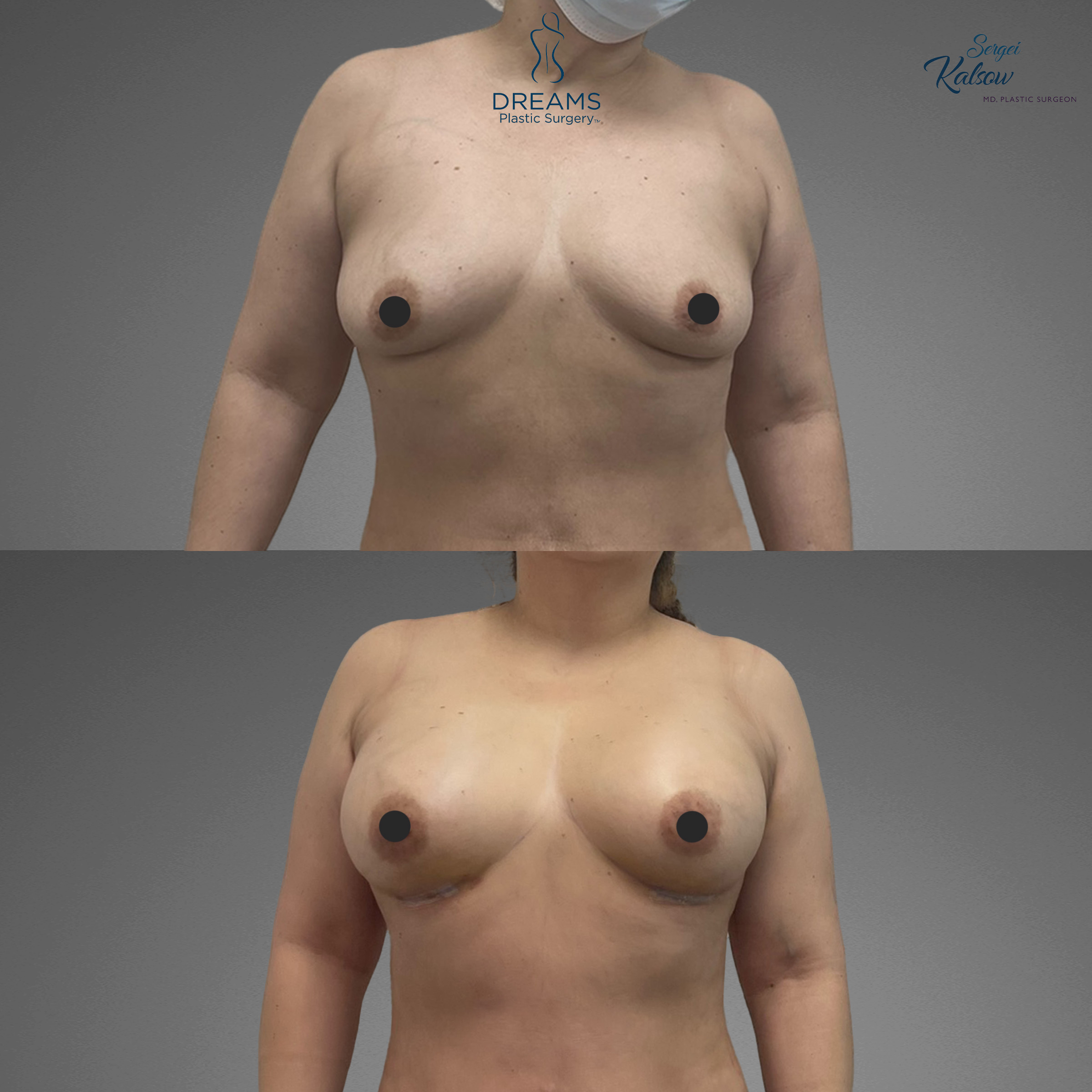 Breast augmentation before and after result case 5