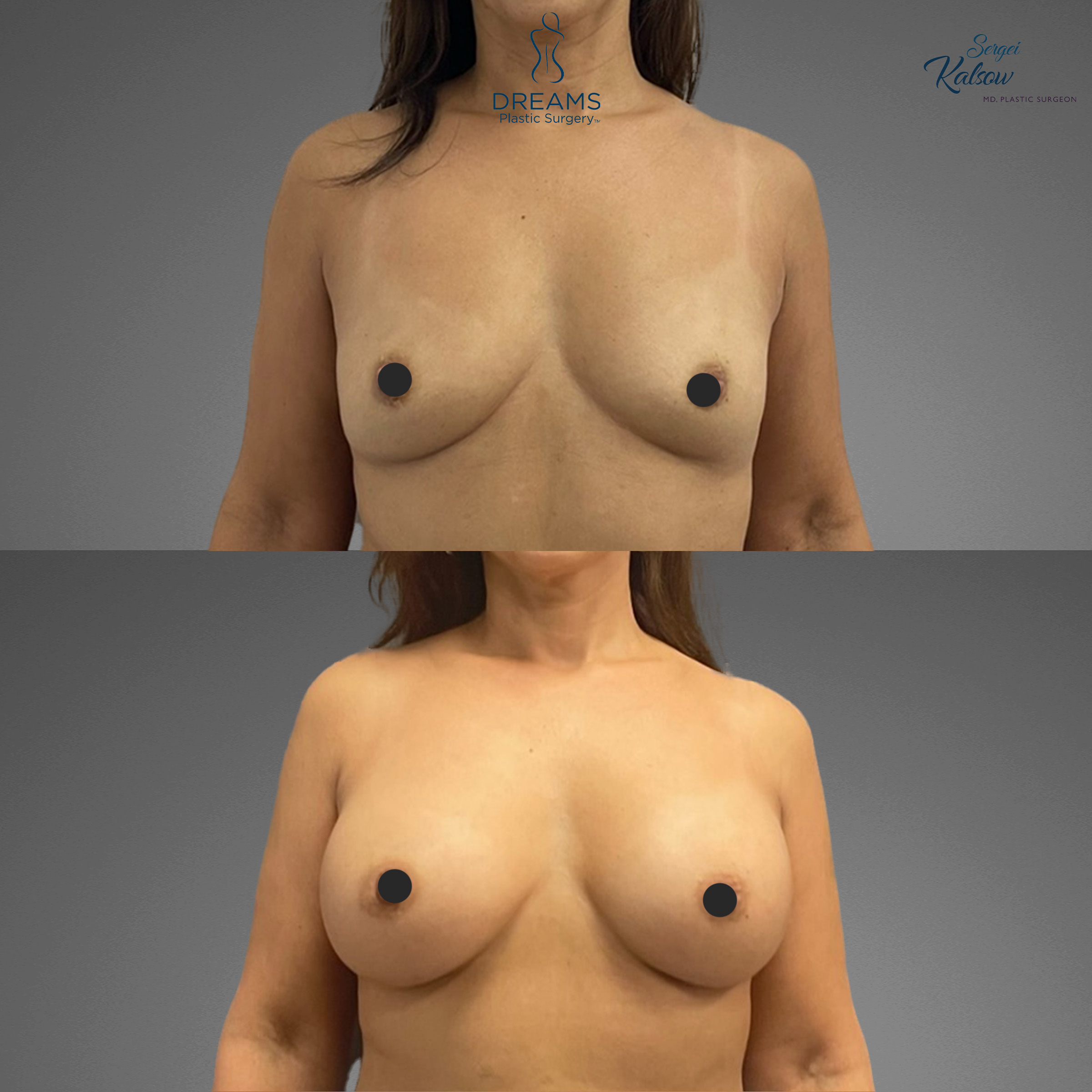 Breast augmentation before and after result case 7