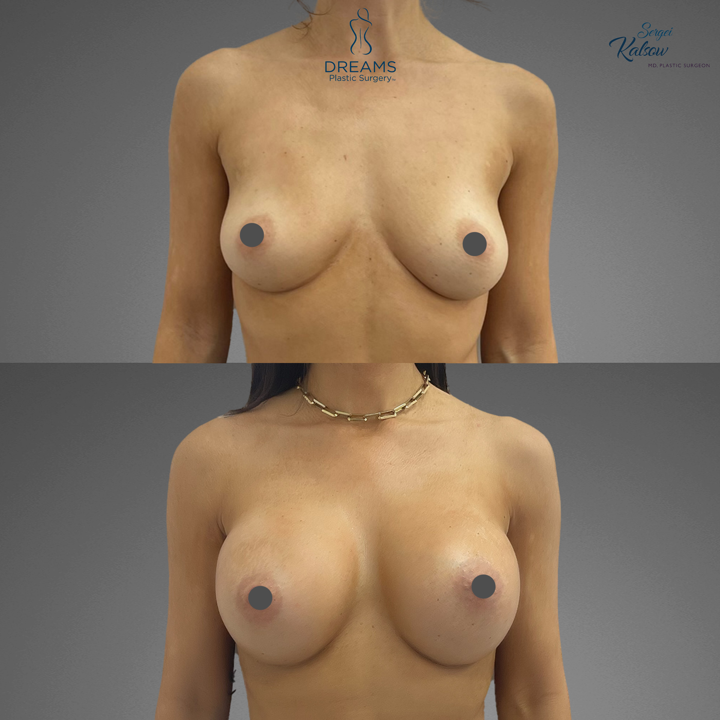 Breast augmentation before and after result case 8
