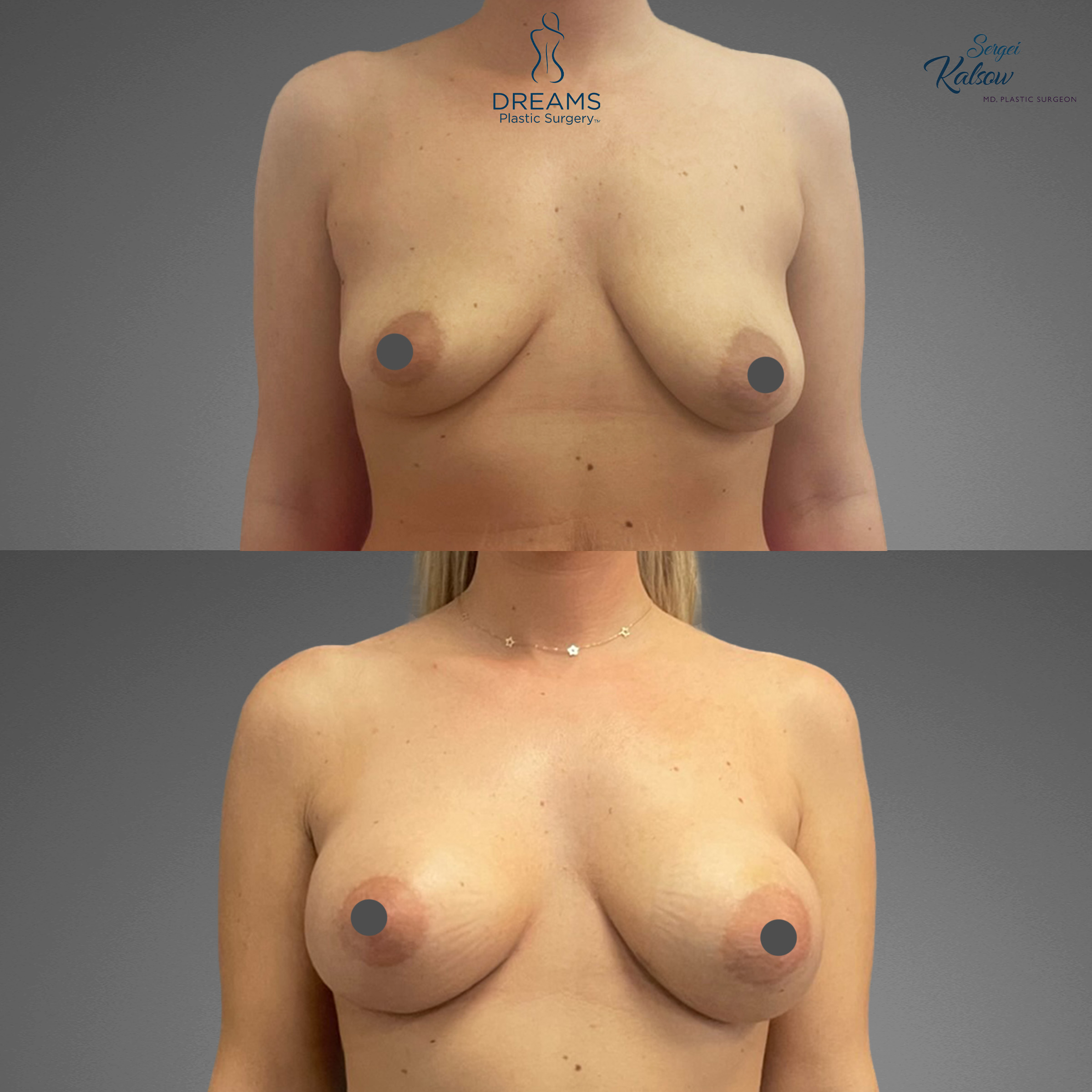 Breast augmentation before and after result case 10