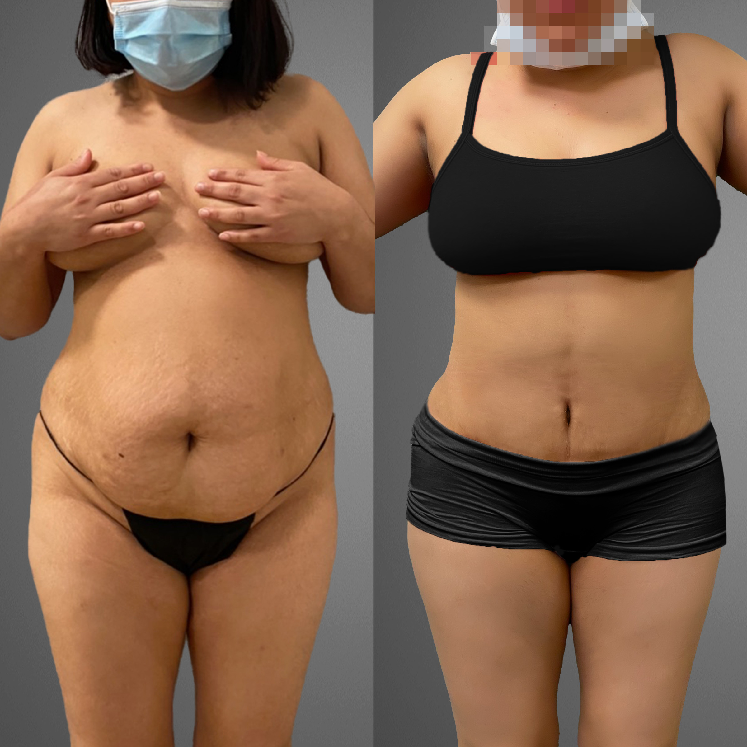 Mommy makeover front view before and after result case 2