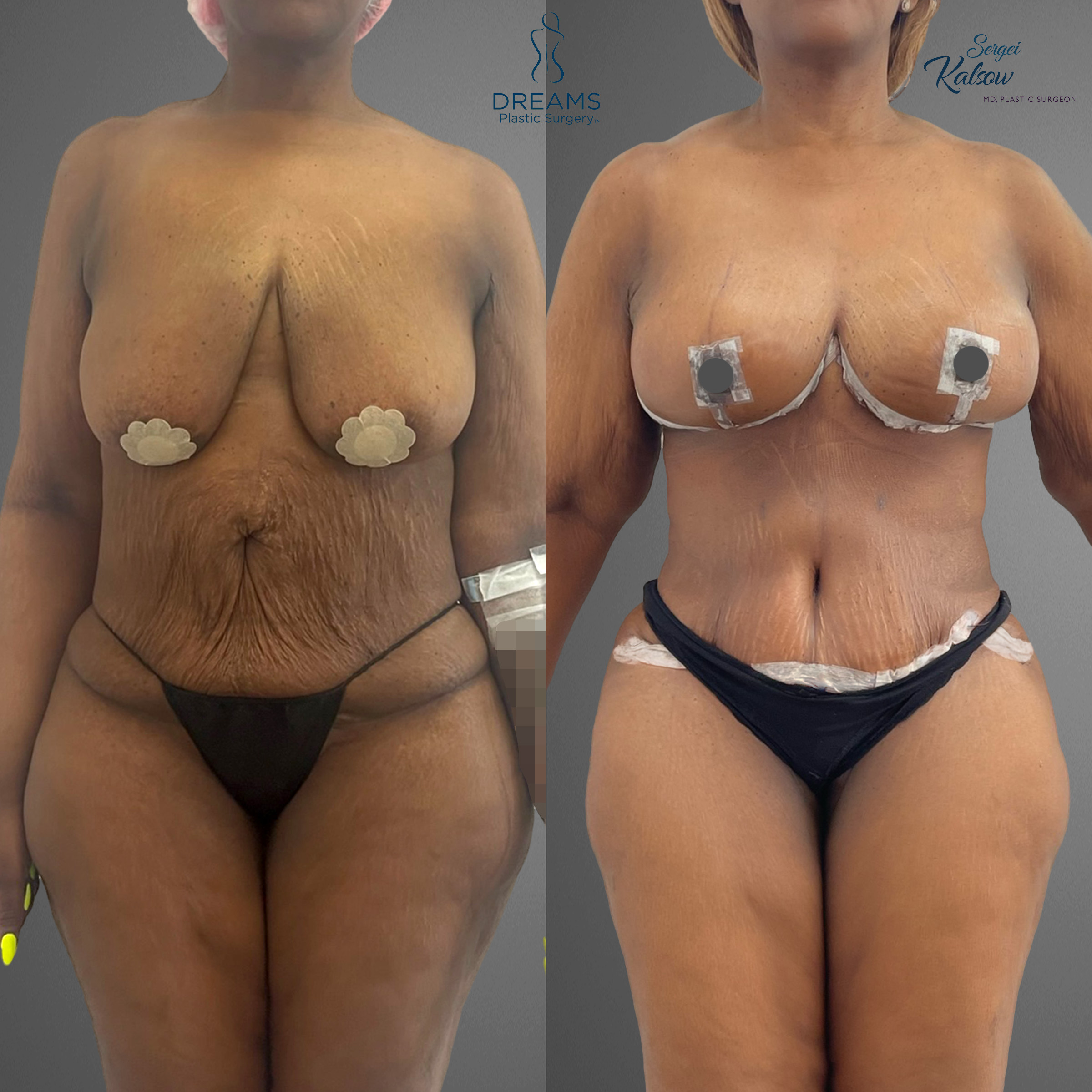 Mommy makeover front view before and after result case 3