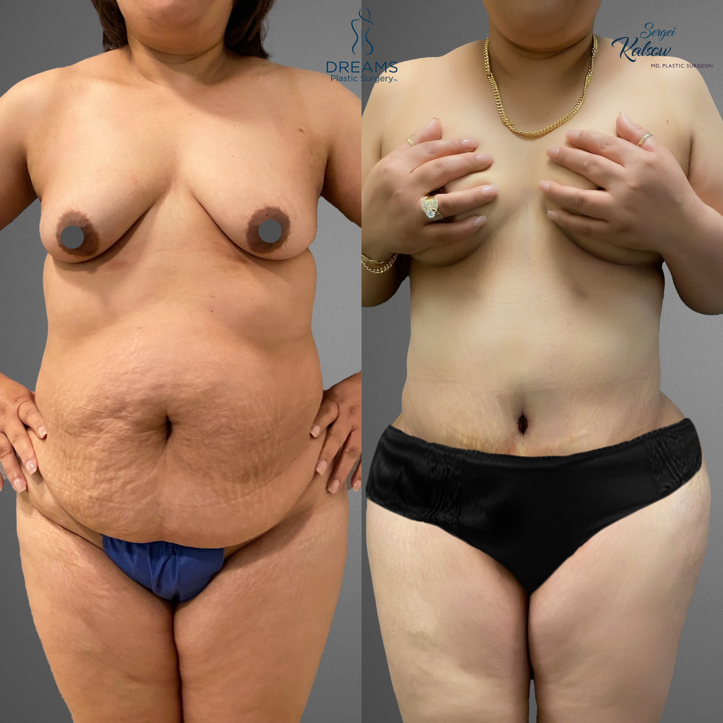 Mommy makeover front view before and after result case 4