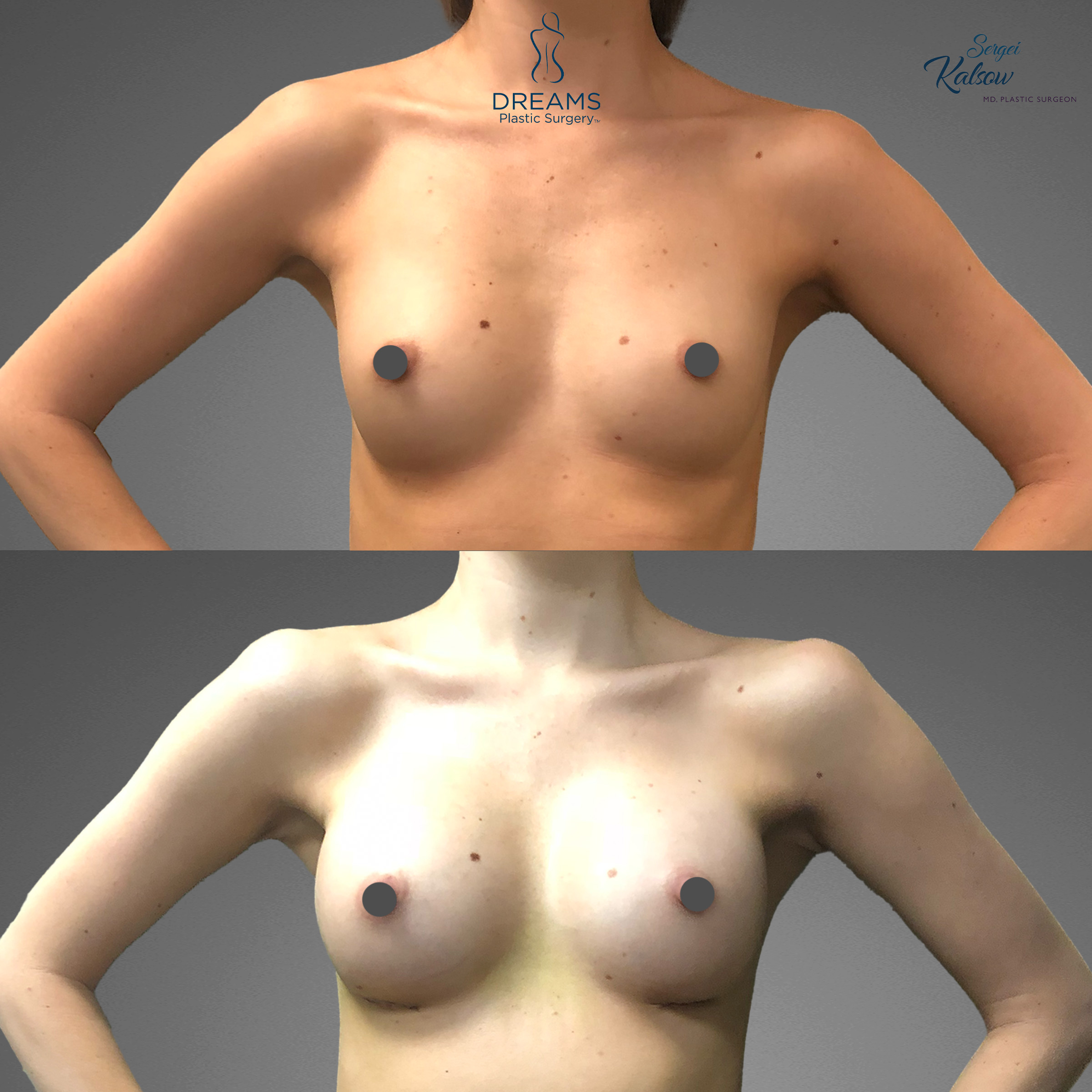 Breast augmentation before and after result case 3