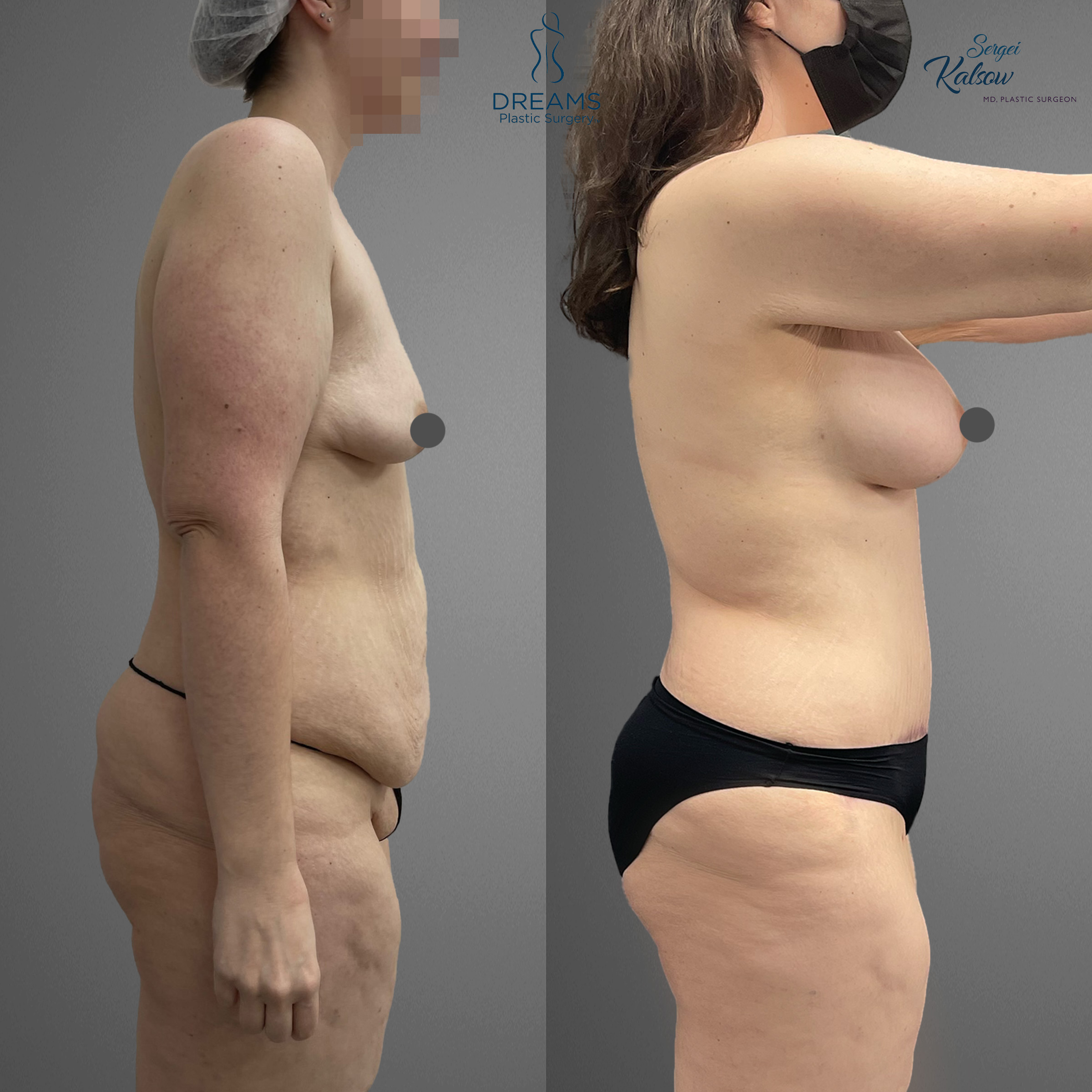 Mommy makeover side view before and after result