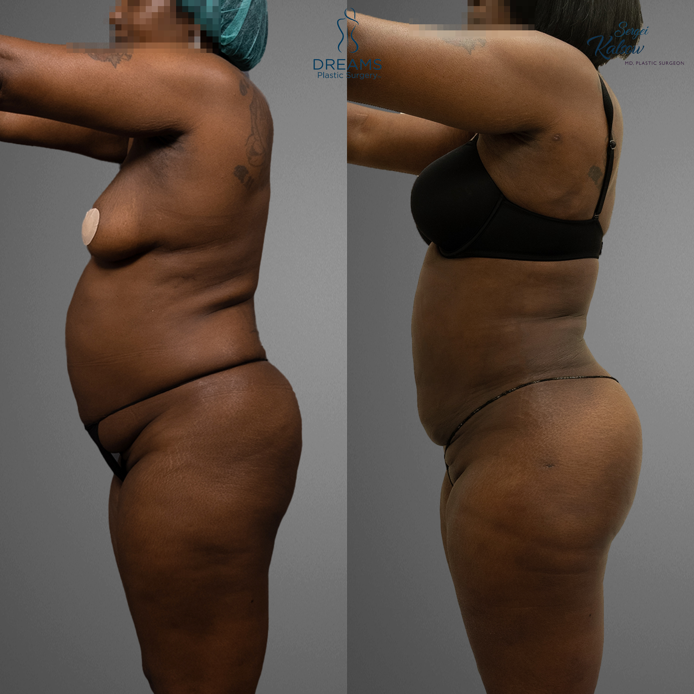 Liposuction before and after side view result