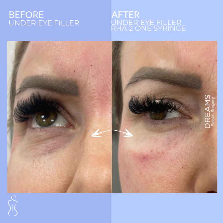 Under eye filler before and after result in NYC