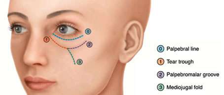 Tear trough under eye filler placement areas